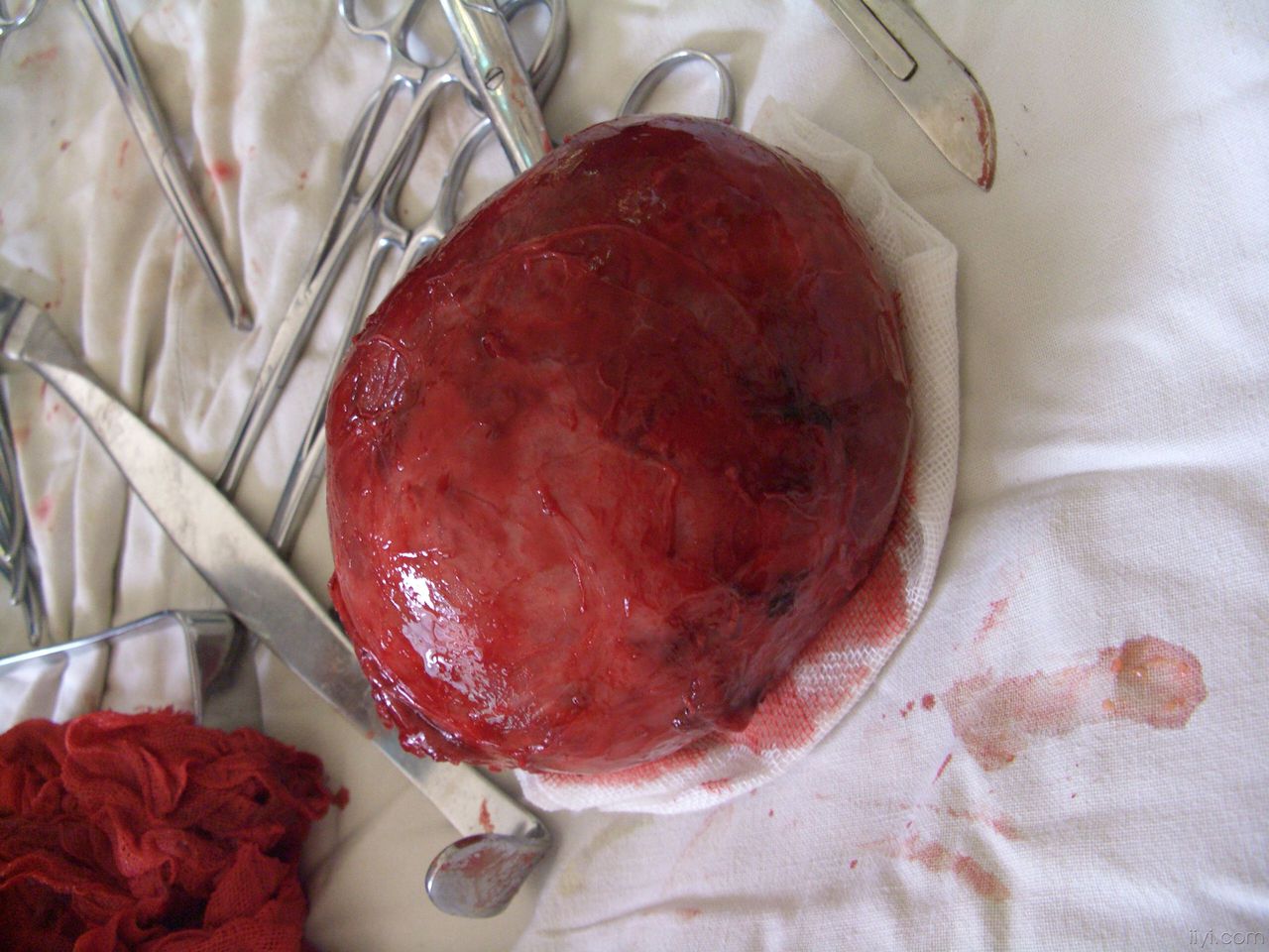 甲状腺囊腺瘤