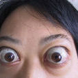 甲状腺性突眼