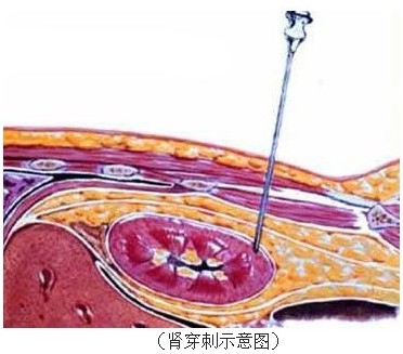 肾脏穿刺术 肾脏穿刺术