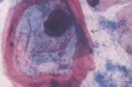 HSV(单纯疱疹病毒(Herpes simplex virus))