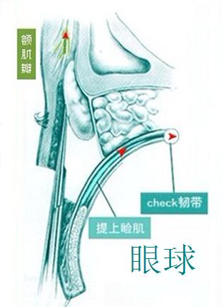 上睑下垂矫正术加强睁眼力量的力学方向 上睑下垂矫正术加强睁眼力量的力学方向